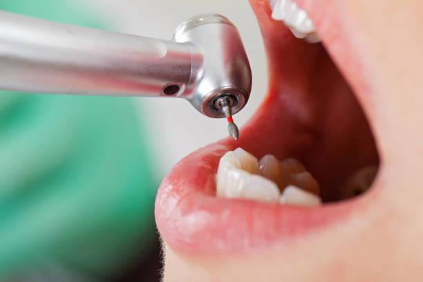 Best Emergency Dental Care for Broken or Chipped Teeth in Comanche, TX